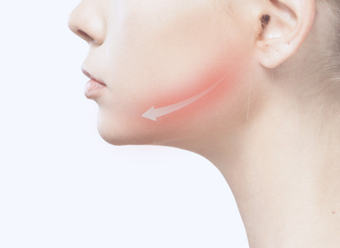 Profil d'une femme qui explique chirurgie orthognatique